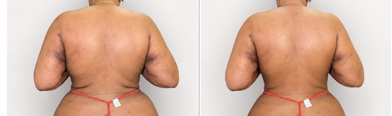 Lipolysis Treatment